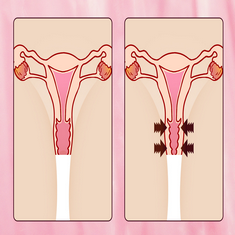 收紧阴道壁